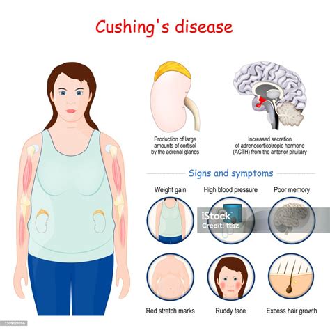 1. 10+ Cushing's Disease Insights: Essential Female Health Guide