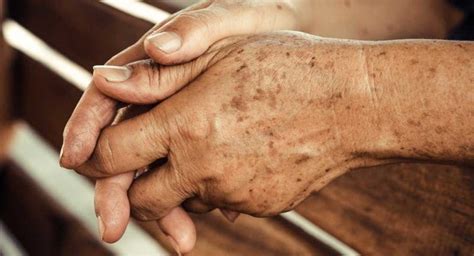 1. The Ultimate Guide To Identifying 7 Liver Spots On Hands