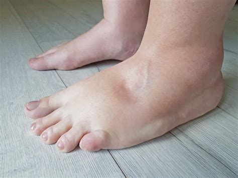 10 Causes For Swollen Feet Why Your Feet Ankles Legs Swell Lupon Gov Ph