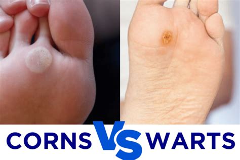 10+ Plantar Warts: The Ultimate Guide To Contagion And Prevention