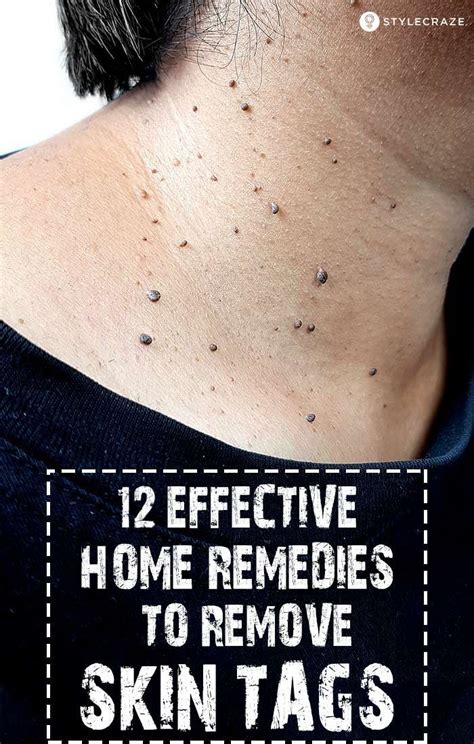 12 Home Remedies To Remove Skin Tags Naturally Artofit