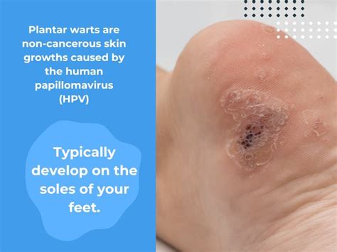 15 Facts About Plantar Warts: A Comprehensive Overview Of Their Contagious Nature