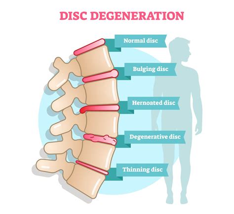 15+ Level Multilevel Degenerative Disc Treatment Ideas