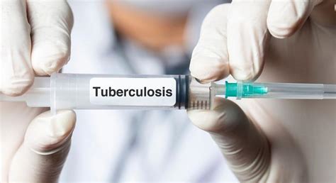 1St New Tb Vaccine In 100 Years Advances As Wellcome Gates Foundation