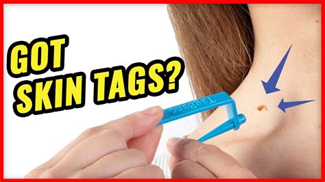 2. 10 Pro Tips For Effective Skin Tag Removal Now