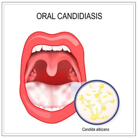 2. Perfect Your Knowledge: 5 Urgent Steps To Address Oral Yeast Infections Now