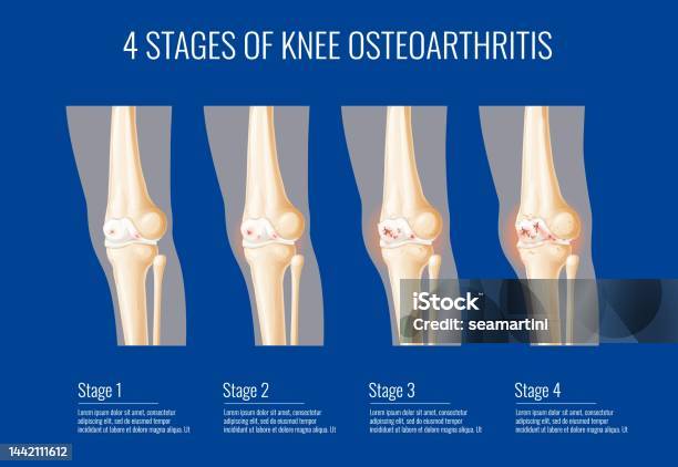 4 Stages Of Knee Osteoarthritis Arthritis Joint Pain Treatment