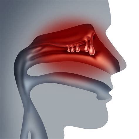 Acute Sinusitis Guide Causes Symptoms And Treatment Options