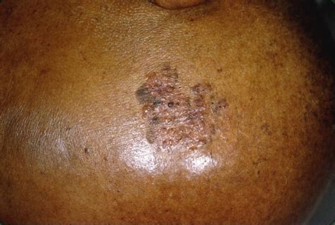 African American Skin Cancer Photos And Premium High Res Pictures