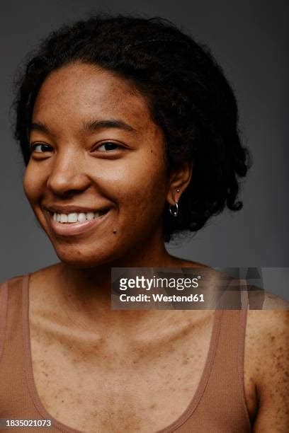 African American Skin Cancer Stock Photos Pictures Royalty Free