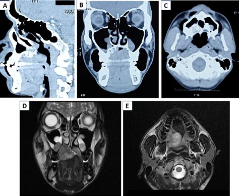 An Extensive Nodular Lesion Involving Hard Palate And Nasal Turbinate