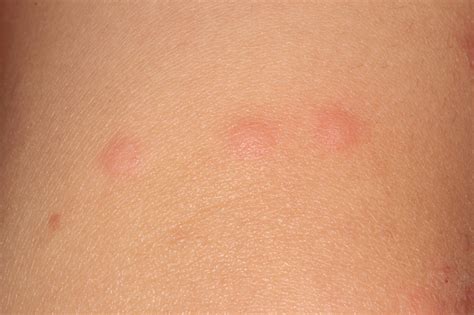 Bed Bug Rash Pictures