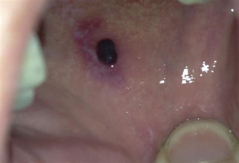 Blood Blister In Mouth Pictures And Treatment Dental Implants Chula