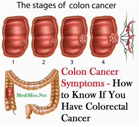 Cancerous Colon Polyp Images