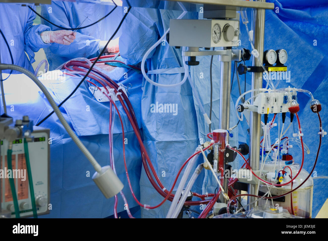 Cardiopulmonary Bypass Diagram