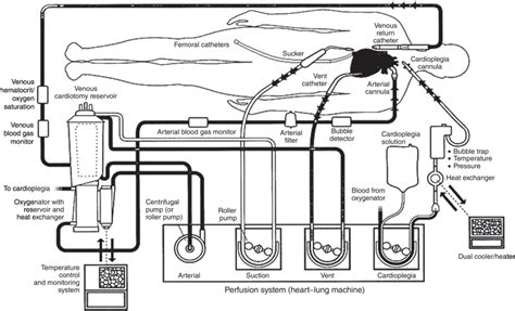 Cardiopulmonary Bypass Machine Diagram