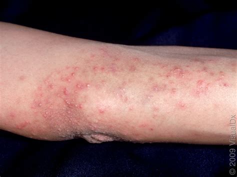 Celiac Disease Rash Overview Symptoms And Treatment Healthpulls