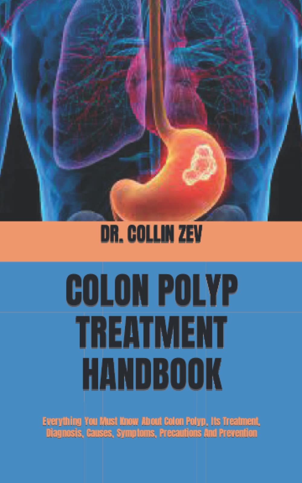 Colon Polyp Symptoms Causes Diagnosis Treatment