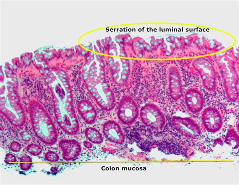 Pictures Of Polyps In Colon - Immuno Oncology