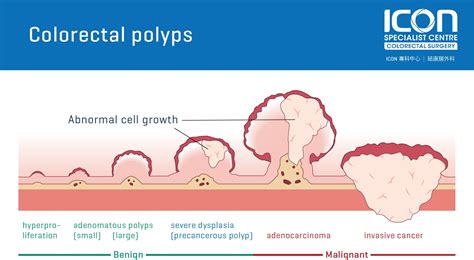 Pictures Of Polyps In Colon - Immuno Oncology