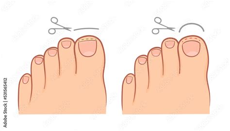 Correct And Improper Cutting Of The Toenail Medical Illustration Stock