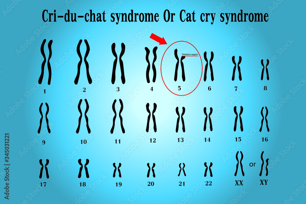 Cri Du Chat Syndrome Cat S Cry Syndrome Monosomy 5P Ppt Download