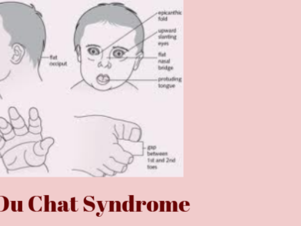 Cri Du Chat Syndrome Medizzy