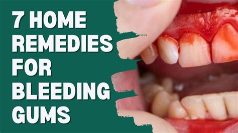 Design 7 Powerful Remedies For Bleeding Gums Today