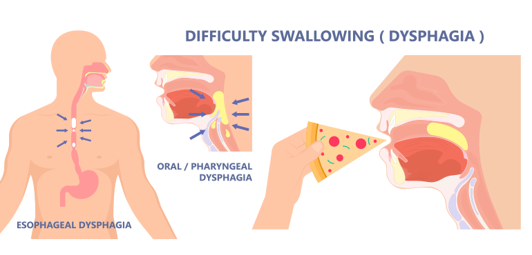 Difficulty In Swallowing Dysphagia Research Library Omi Hospital