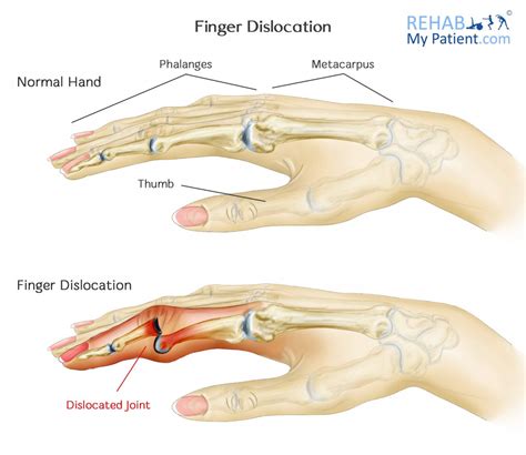 Dislocated Finger Symptoms Causes Treatment Rehabilitation