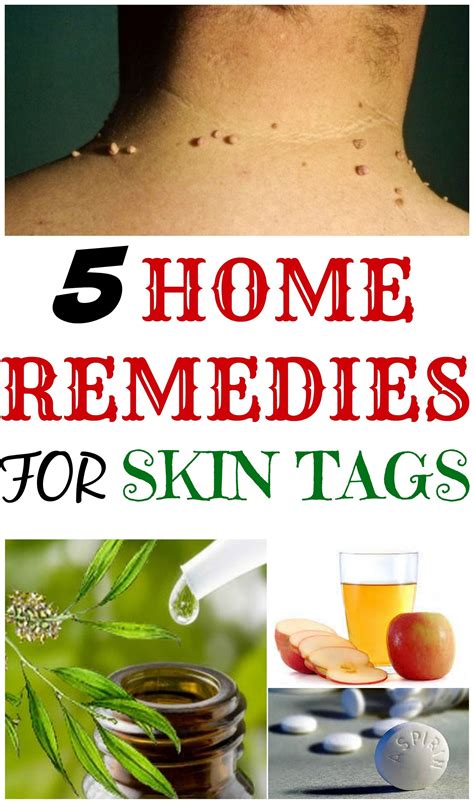 Effective Diy Remedies To Remove Skin Tags