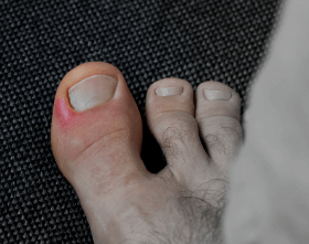 Expert Treatment For Paronychia In North Seattle Foot And Ankle