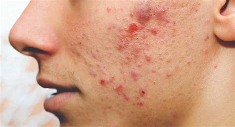 Facial Health 5 Common Foods That Causes Pimples And Dark Spots