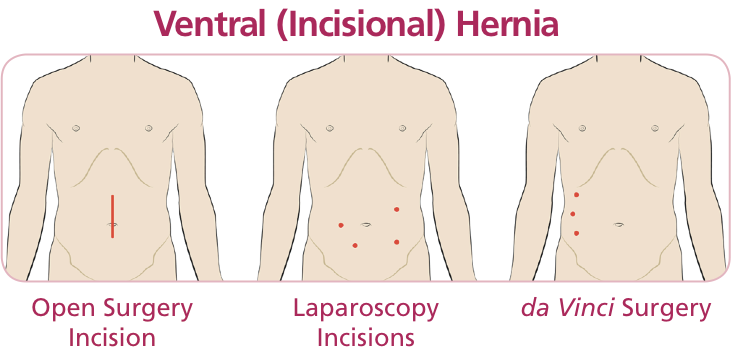 General Surgeons Hernia Repair