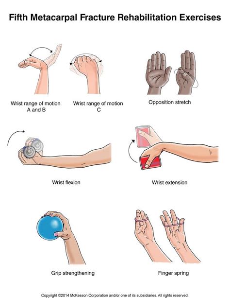 Hand Fracture Fifth Metacarpal Boxer S Fracture Exercises Physical