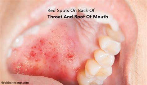 Have Had This Rash On The Roof Of My Mouth Back Of Throat That Comes