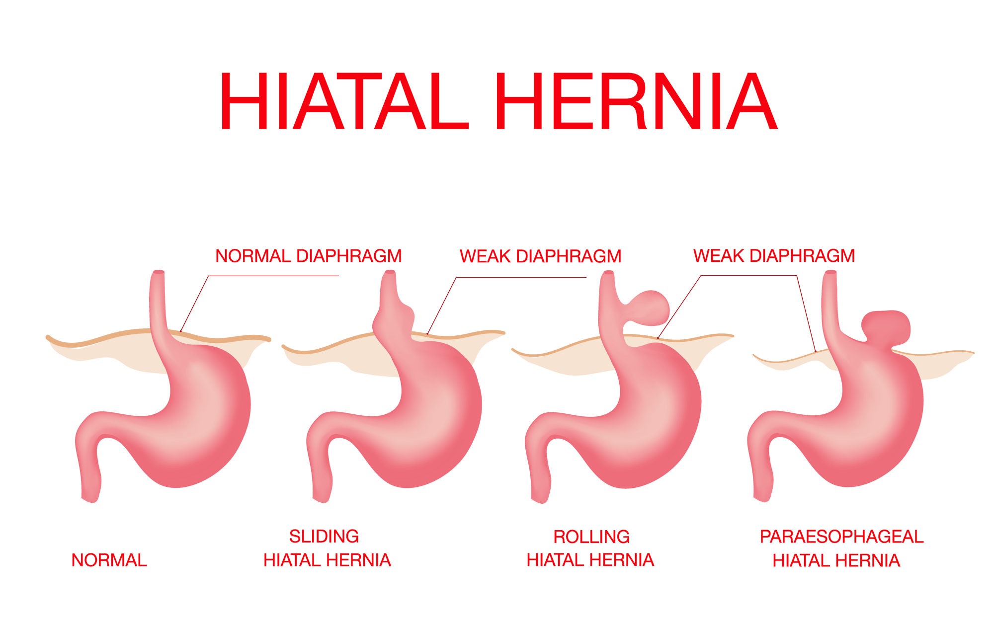 Hiatal Hernia Types