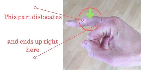 How To Fix A Dislocated Finger Knuckle