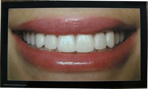 Ideal Smile Poster Los Angeles Institute Of Clinical Dentistry Ruiz