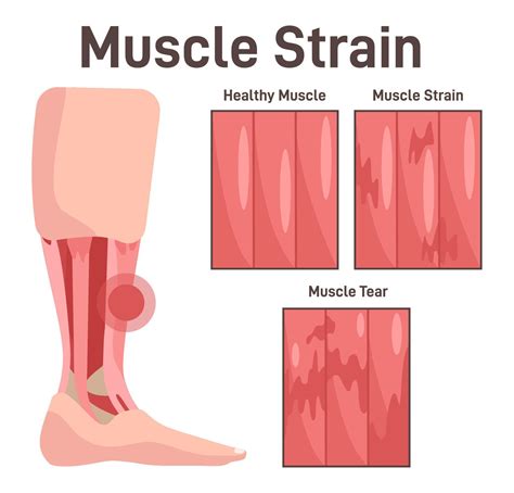 Leg Muscle Injury Muscle Strain At Different Stages Healthy Strained