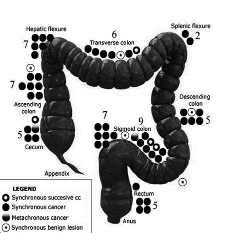 List 90 Pictures Pictures Of Cancerous Colon Polyps Updated