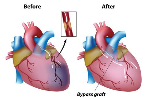 Minimally Invasive Coronary Artery Bypass Grafting Conditions