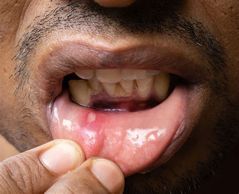 Mouth Sores Pictures Causes Types Symptoms And Treatments