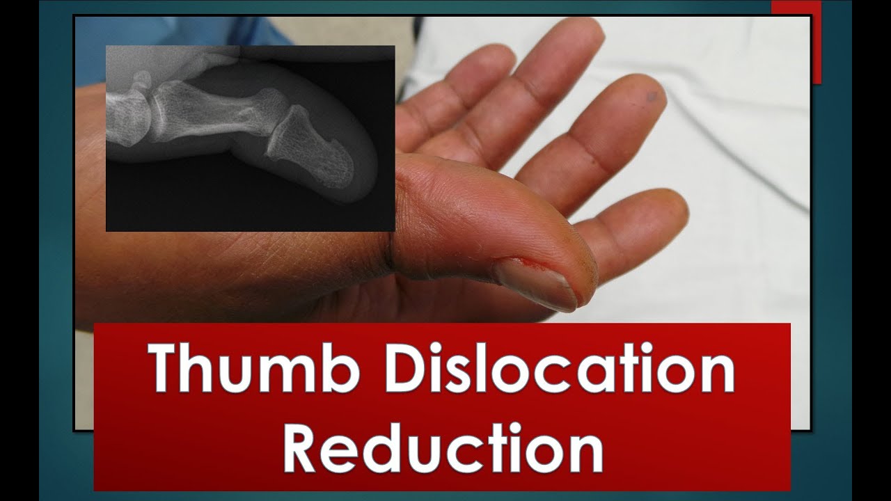 Movement After Treatment For Ring Finger Dislocation Youtube