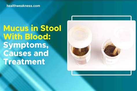 Mucus In Stool With Blood Symptoms Causes Treatment 2025