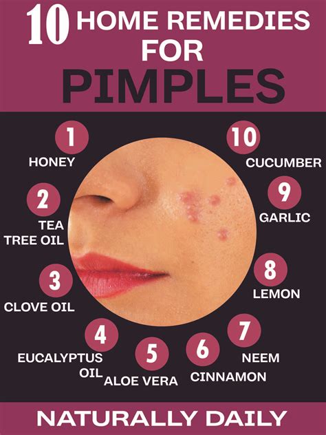 Natural Home Remedies For Pimples Homeremediesforpimples Pimples