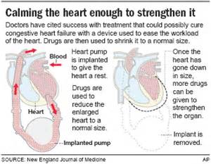 New Pump Can Help Reverse Heart Failure