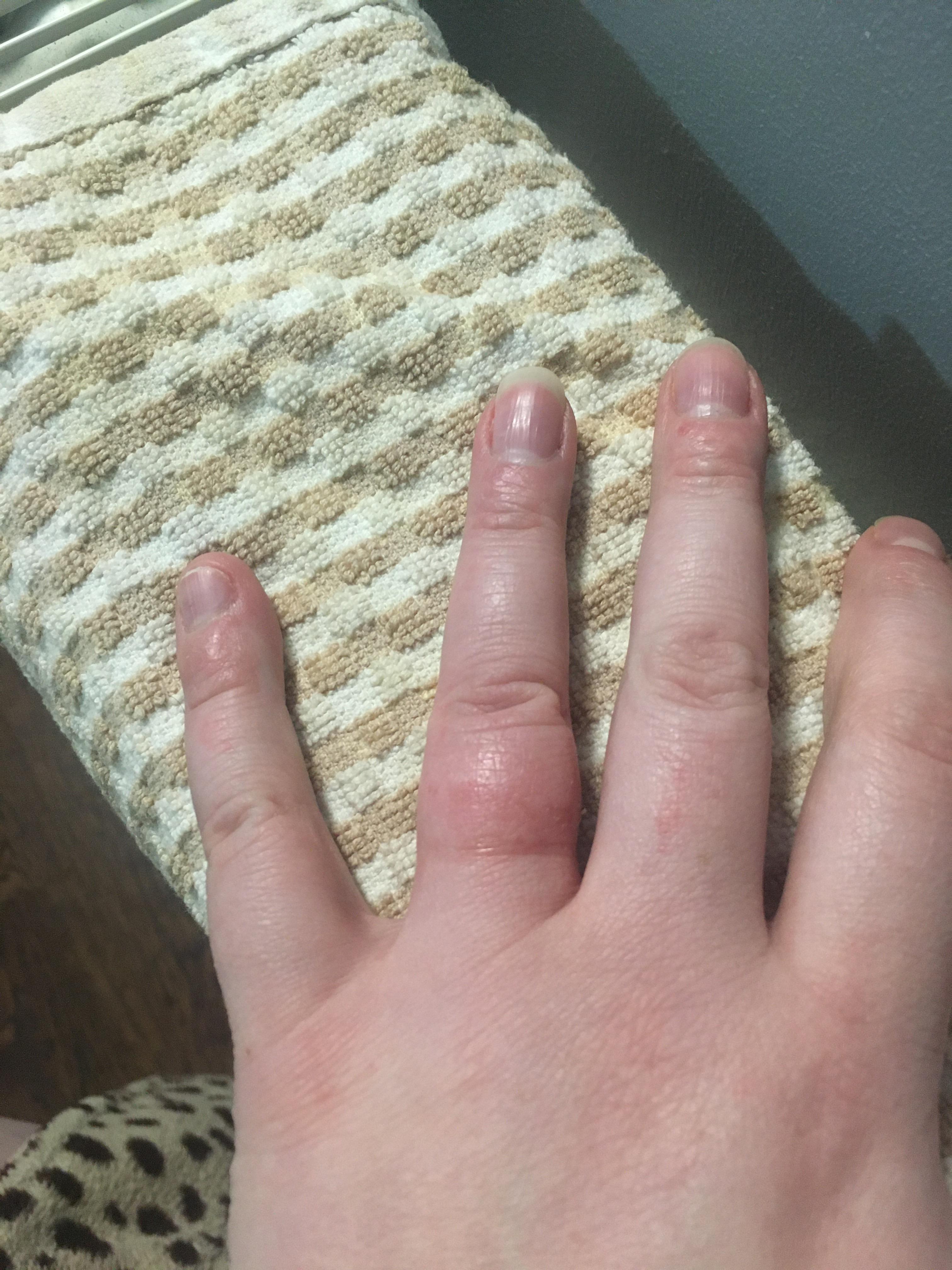 Not Horrible But This Is My Finger After My Ring Needed To Be Cut Off