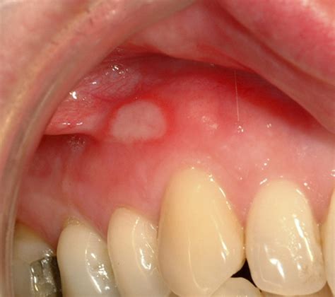 Oral Mucosal Disease Recurrent Aphthous Stomatitis