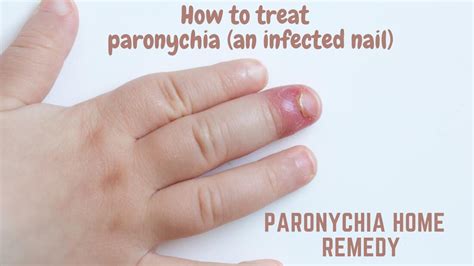 Paronychia Home Remedy How To Treat Paronychia An Infected Nail